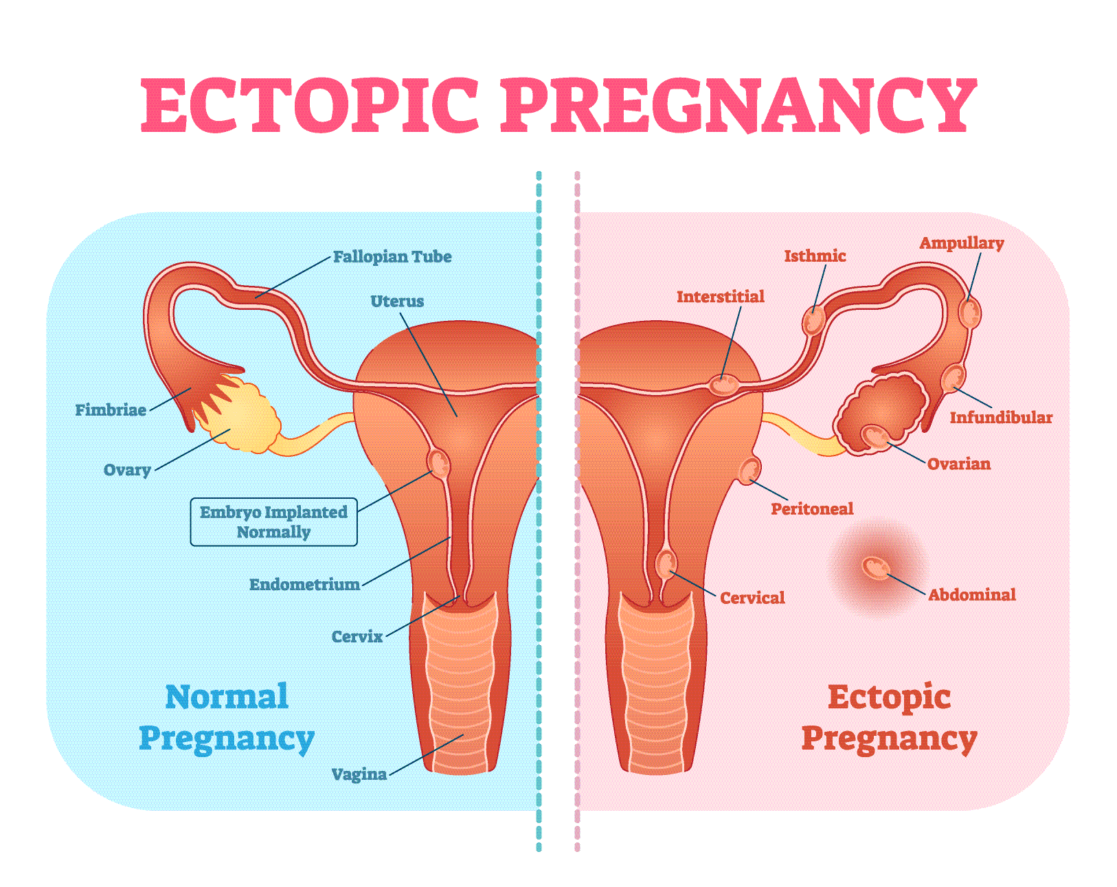 Tubal Pregnancy